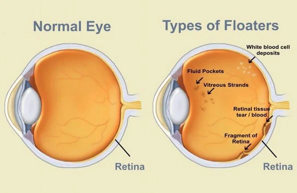 Floaters pada Mata: Penyebab, Gejala, dan Cara Mengatasinya