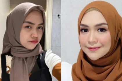 Ibunda Ria Ricis Terkejut Saat Pertama Tahu Putrinya Mengalami Operasi Hidung