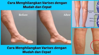 Atasi Varises dengan 3 Cara Alami Ini