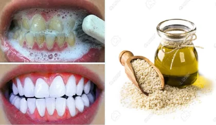 Cara Bersihkan Karang Gigi dengan 4 Bahan Alami