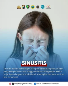 Pilek Tak Sembuh Lebih dari 10 Hari? Waspada Gejala Gangguan Sinus