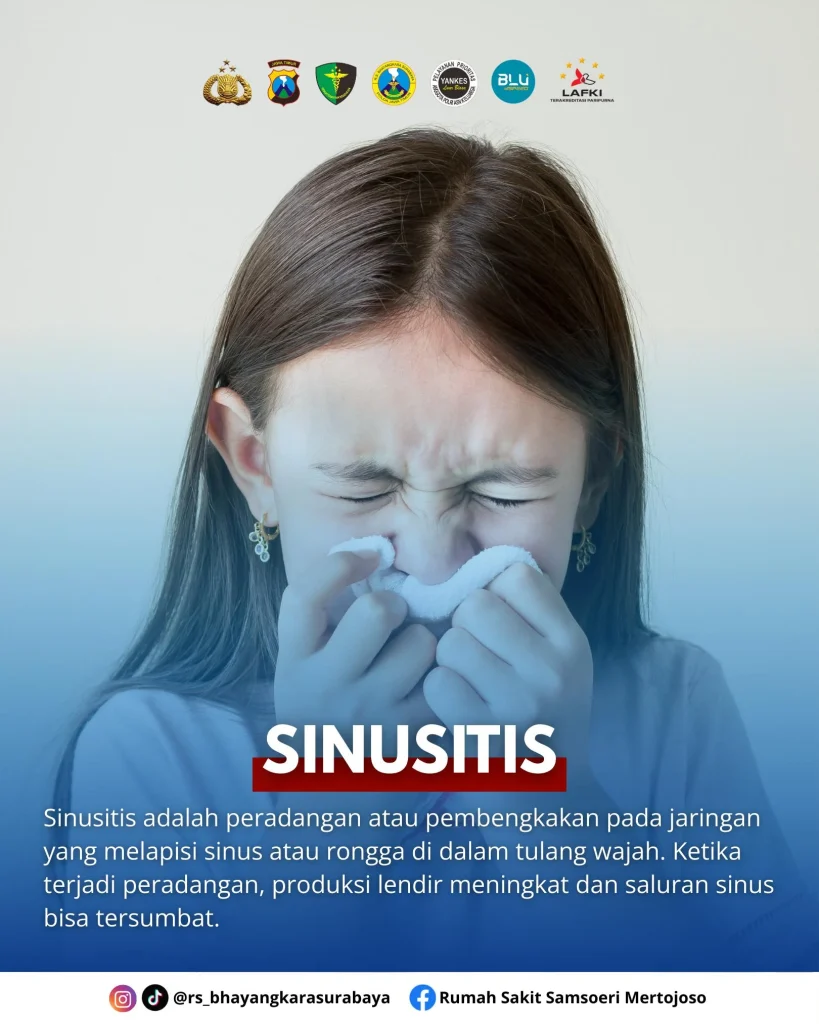 Pilek Tak Sembuh Lebih dari 10 Hari? Waspada Gejala Gangguan Sinus