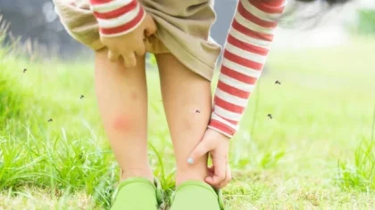 Waspada Monkey Malaria: Gejala, Penularan, dan Wilayah yang Rentan Terpapar