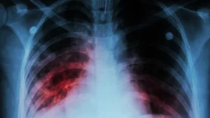 Menkes Usulkan Penderita Tuberkulosis Terima MBG