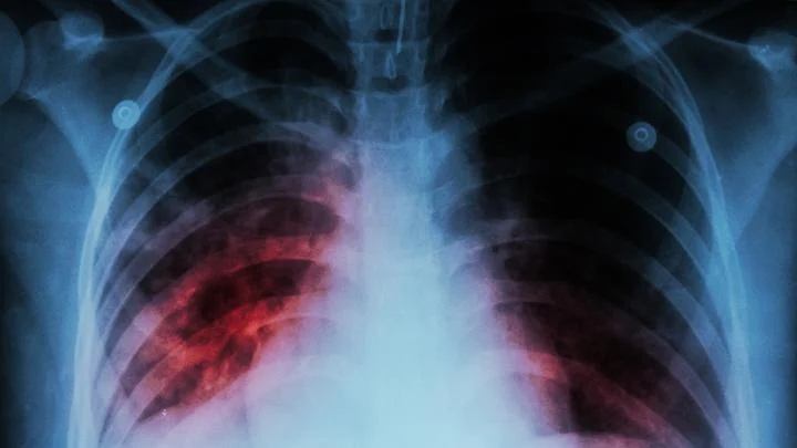 Menkes Usulkan Penderita Tuberkulosis Terima MBG